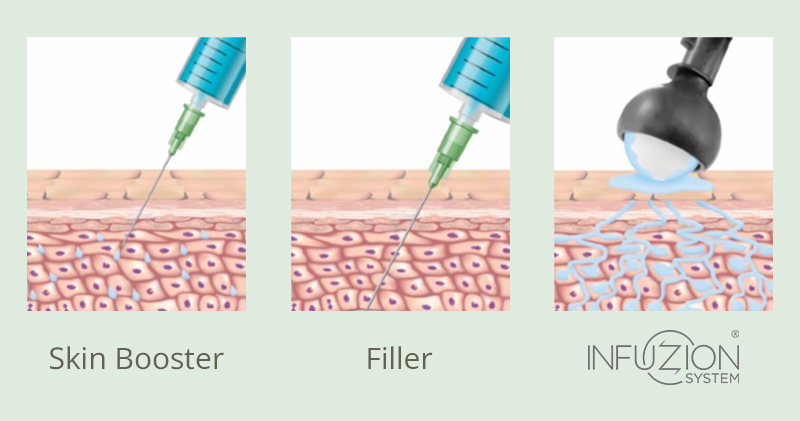 Grafische Darstellung von Hautschichten bei Injektionen mit Skin Booster und Filler sowie Infuzion System Anwendung.​​​​​​​​​​​​​​​​​​​​​​​​​​​​​