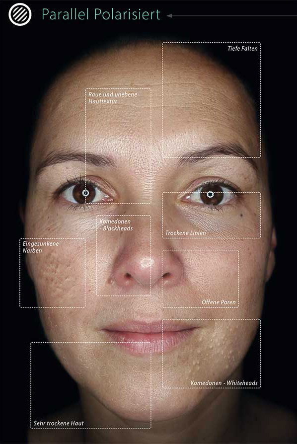 Nahaufnahme eines Gesichts mit Falten, offenen Poren, Whiteheads, Blackheads und trockener Haut unter polarisiertem Licht.​​​​​​​​​​​​​​​​​​​​​​​