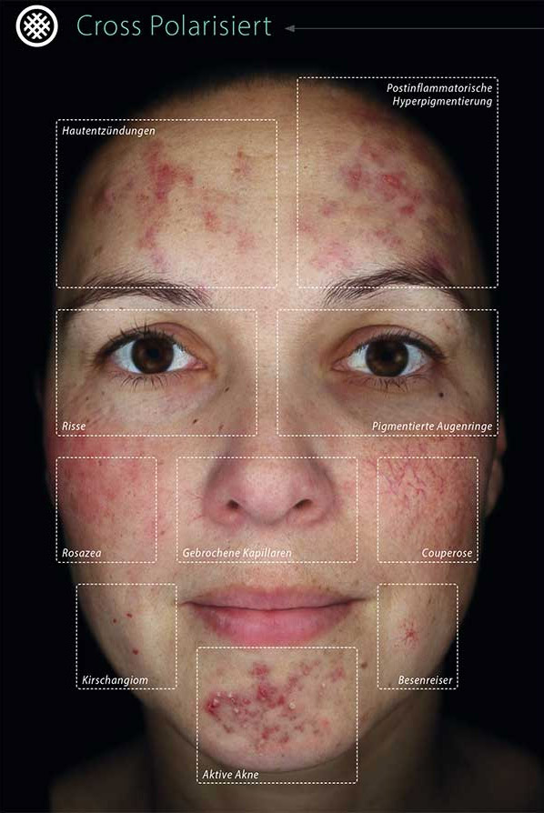 Nahaufnahme eines Gesichts mit Akne, Rosazea, Couperose und Pigmentstörungen unter polarisiertem Licht​​​​​​​​​​​​​​​​​​​​​​​​​​​​​​​​​​​​​​​​​​​