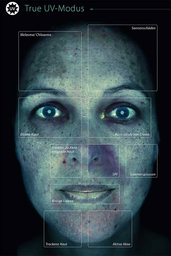 Nahaufnahme eines Gesichts im UV-Licht mit sichtbaren Hautschäden, Akne, Sommersprossen und trockener Haut​​​​​​​​​​​​​​​​​​​​​​​​​​​​​​​​​​​​​​​