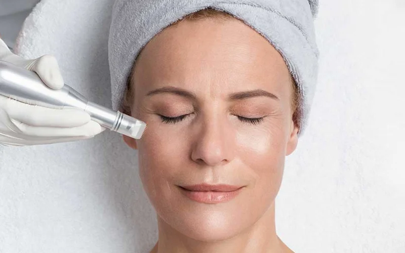 Mikrodermabrasion